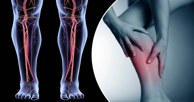 Środki zaradcze i naturalne kremy przeciw żylakom