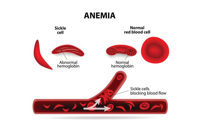 Diagnoza i leczenie anemii