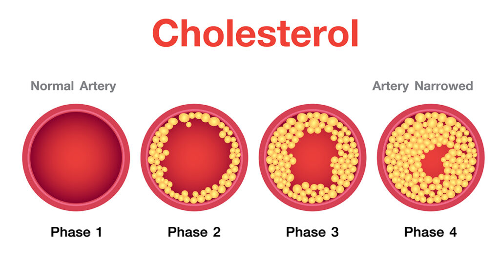 Jaki jest normalny poziom cholesterolu?
