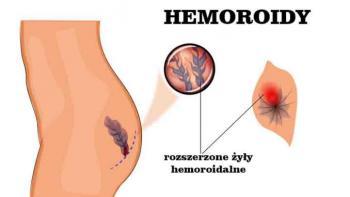 Naturalne środki zaradcze przeciw hemoriodom