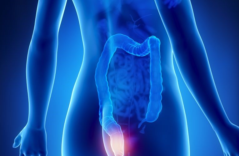 Hemoroidy - objawy, czynniki ryzyka, dieta, leczenie i naturalne środki zaradcze