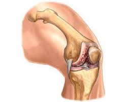Jak stosuje się Holdaflex? Wskazania, stosowanie i dawkowanie